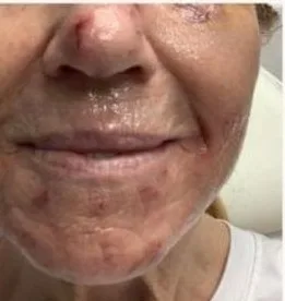 Before: BBL photofacial, redness and pigment at Vero Beach Medical Spa