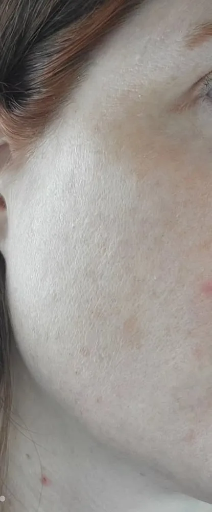 10 days after: BBL photofacial, first treatment at Vero Beach Medical Spa