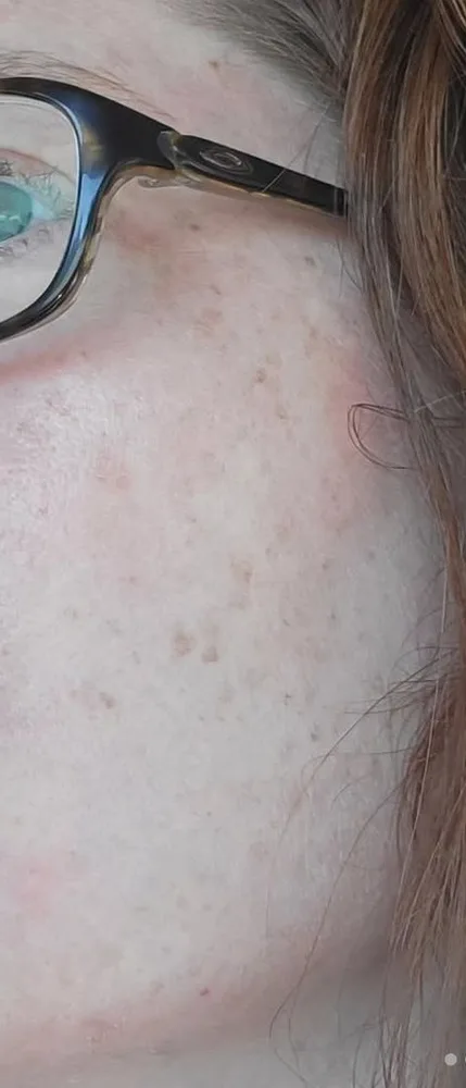 Before: BBL photofacial, first treatment at Vero Beach Medical Spa