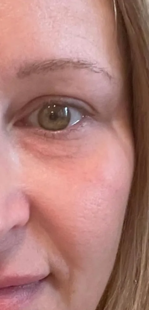 Before: Xeomin, crow's feet and under-eye lines at Vero Beach Medical Spa