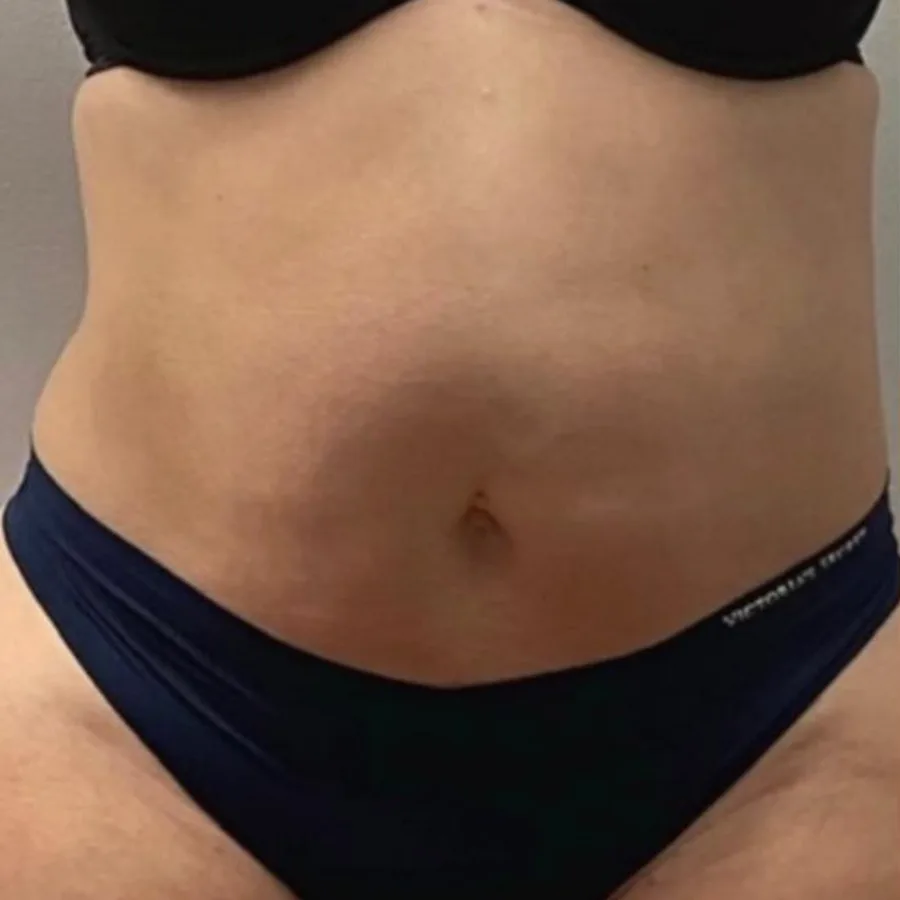 Before: Dr. Million's own EmSculpt Neo result, abdomen at Vero Beach Medical Spa