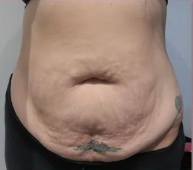 Before: EmSculpt Neo, abdomen, 6 treatments at Vero Beach Medical Spa