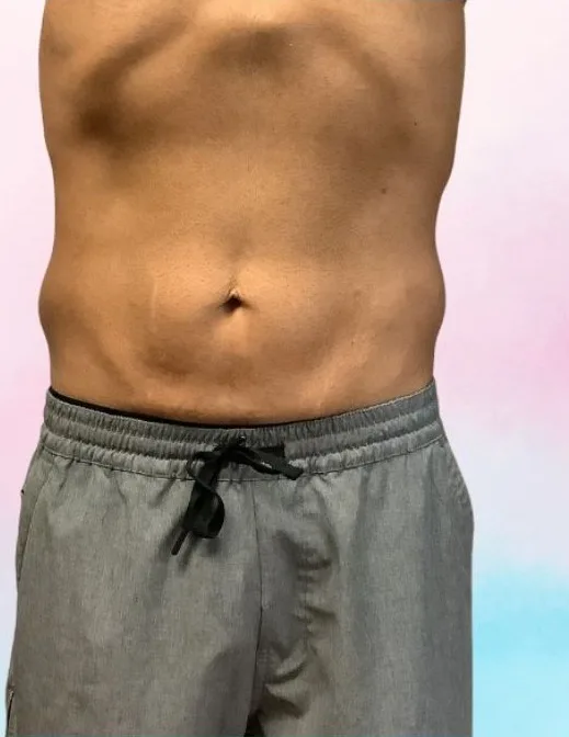 After: EmSculpt Neo, abdomen at Vero Beach Medical Spa