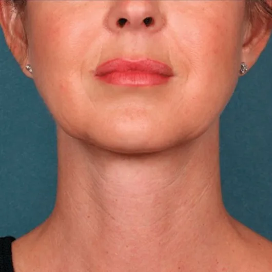 After: Radiesse, jawline and neck at Vero Beach Medical Spa