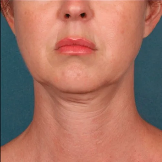 Before: Radiesse, jawline and neck at Vero Beach Medical Spa