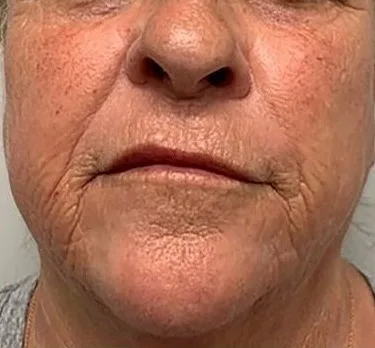 Before: Morpheus8, lower face at Vero Beach Medical Spa