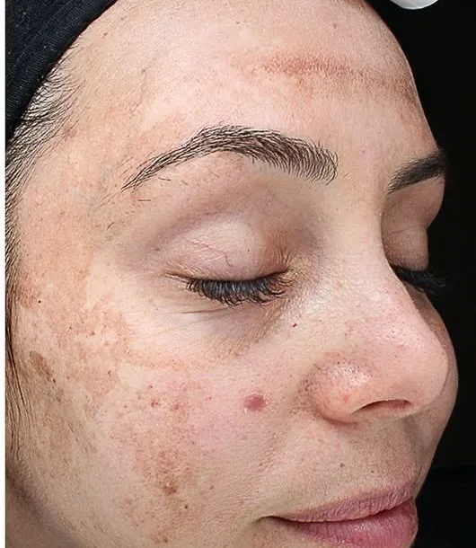 Before: MOXI laser, pigment and tone at Vero Beach Medical Spa