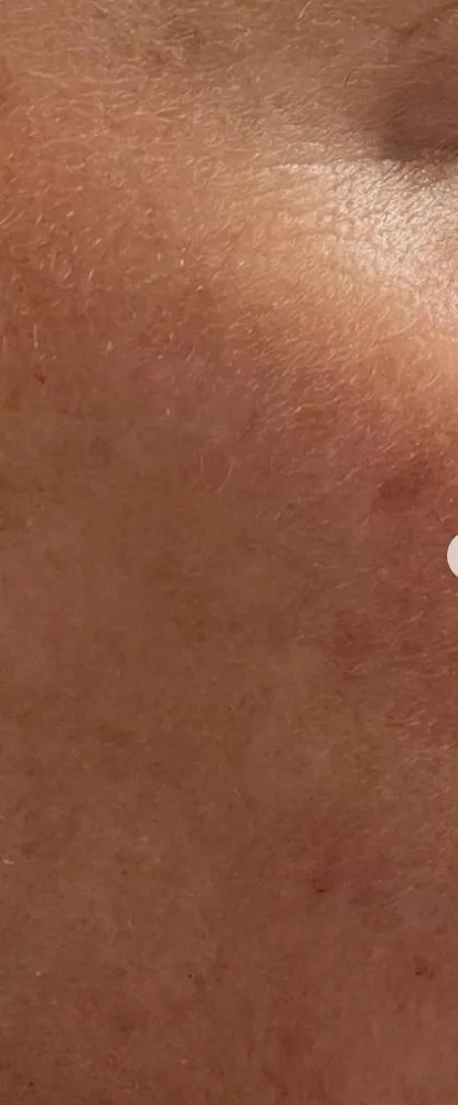 After: MOXI + BBL, cheek at Vero Beach Medical Spa