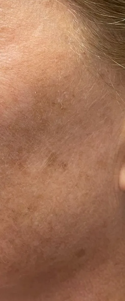 After: MOXI + BBL, cheek at Vero Beach Medical Spa