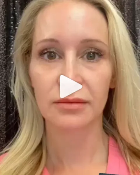 Dr. Million before her triLIFT skin tightening treatment